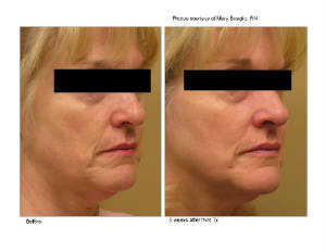 3D_Face_Boaglio_07_B-3A_3wks_right.jpg