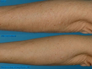 LHR_arm_Waslen_03_B-5A_24wks_front.jpg